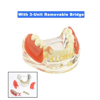 Zubní Výuky Zuby Model S 3 Dolní Čelisti Implantáty Odnímatelný Můstek Pro Zubní Implantát Léčby Demo